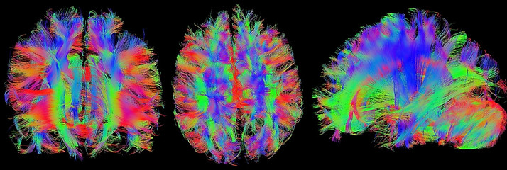 Diffusion tensor imagig of a human brain