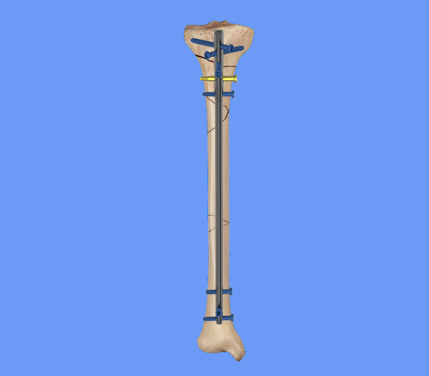 Nite-S Tibial Nail (Universal)