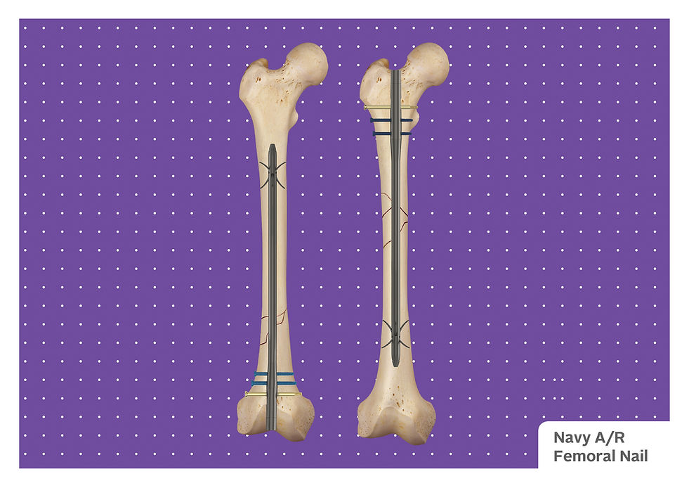 Titanium cannulated Intramedullary Antegrage_Retrograde Femoral Nail for fracture fixation of Femur bone.png