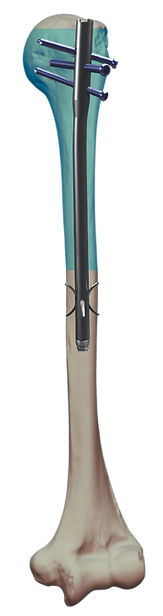 NUNA Humerus (2)_edited.png