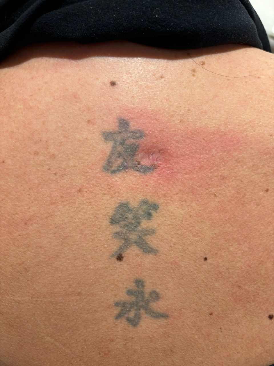Tattoo removal before and after result 3