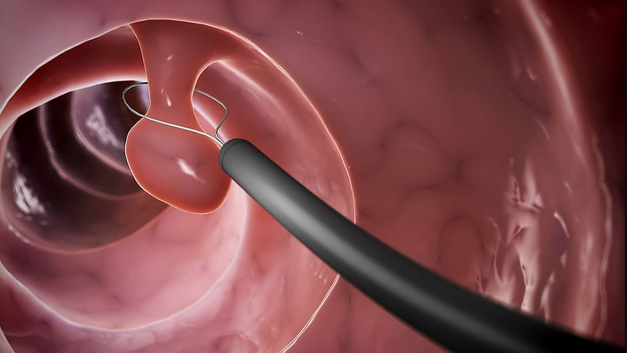 polyp.jpg