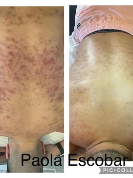 back acne.jpeg