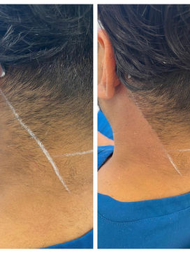 laser hair remove.jpeg