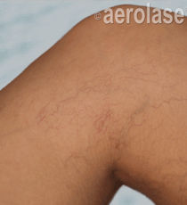 Aerolase B&A Spider Veins.jpeg