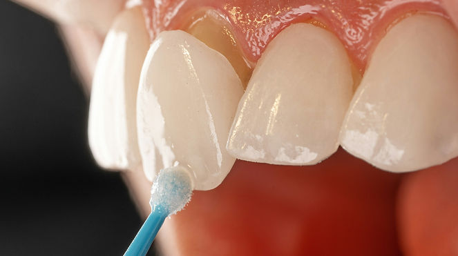 veneers being applies_edited_edited.jpg