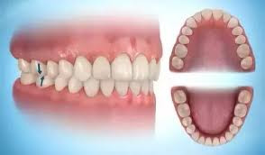 oclusion dental