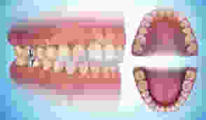 oclusion dental