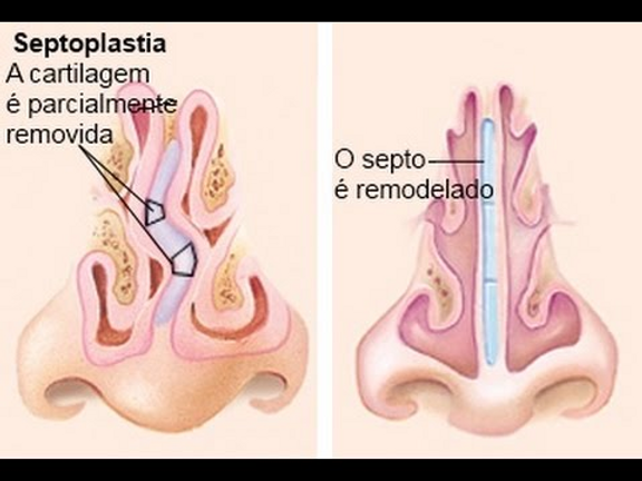 Cartilagem Anatomia Nasal Radiologia Brasileira Complexo