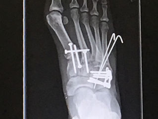 Taking the Pins Out