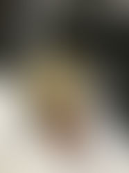 Broken Metatarsal. My first surgery.