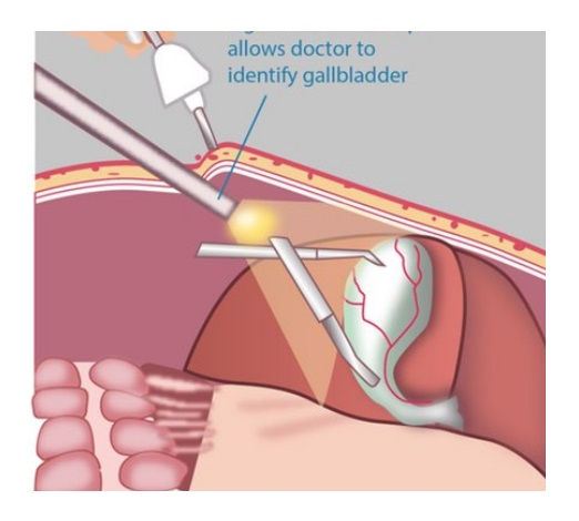 gallstones keyhole surgery - identifying gallbladder