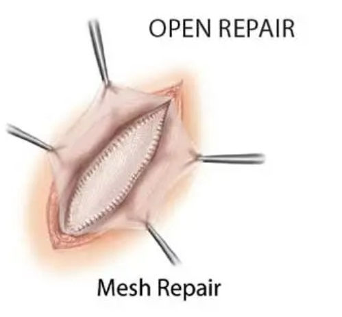 OPEN REPAIR