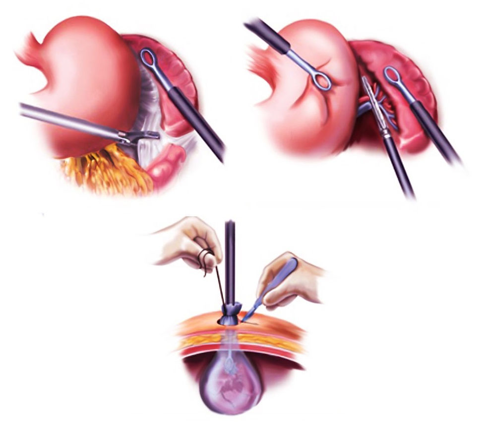 Laparoscopic splenectomy