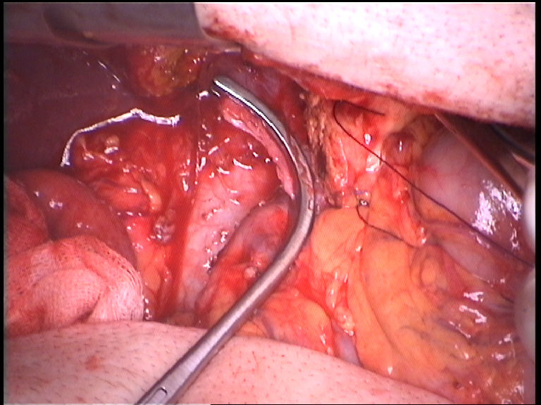 Pancreatic surgery