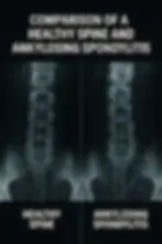 What is Ankylosing Spondylitis? A guide for Nursing Students in Alberta.