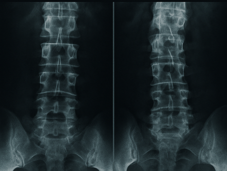 What is Ankylosing Spondylitis?