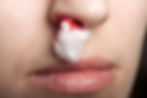 Wound Care - Nosebleed treatment.