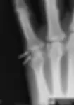Gout Punched Out erosion on bone.