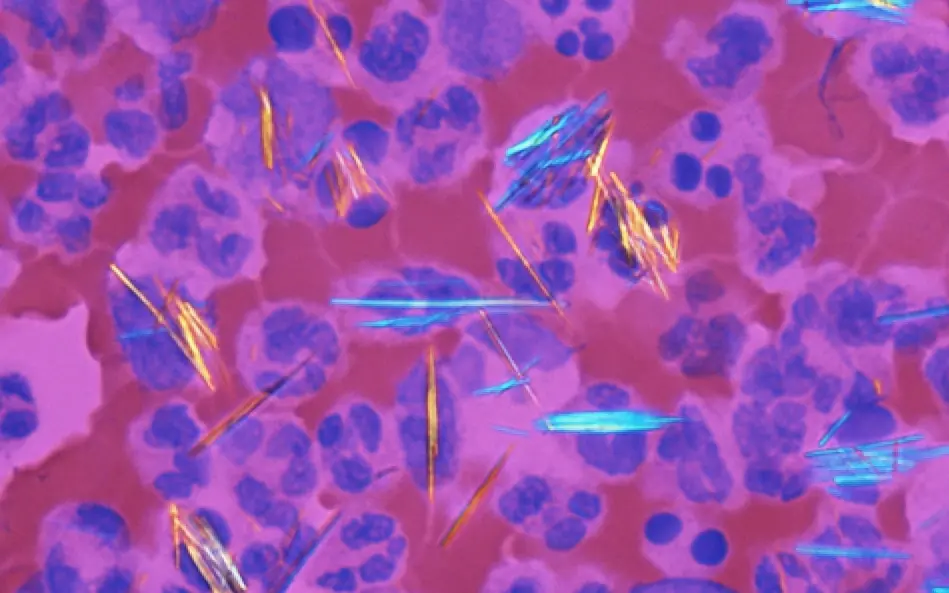 Birefringent crystals in gout.