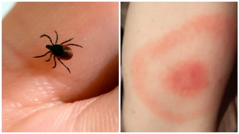 Alberta Tick Bite.