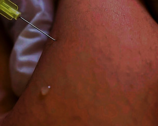 Fat-Dissolving Injections Aftercare | iSkin Clinic | Liverpool Fat-Dissolving Injections Aftercare | iSkin Clinic | Liverpool