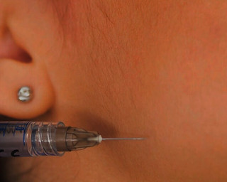 Fat-Dissolving Injections | iSkin Clinic | Liverpool Fat-Dissolving Injections | iSkin Clinic | Liverpool