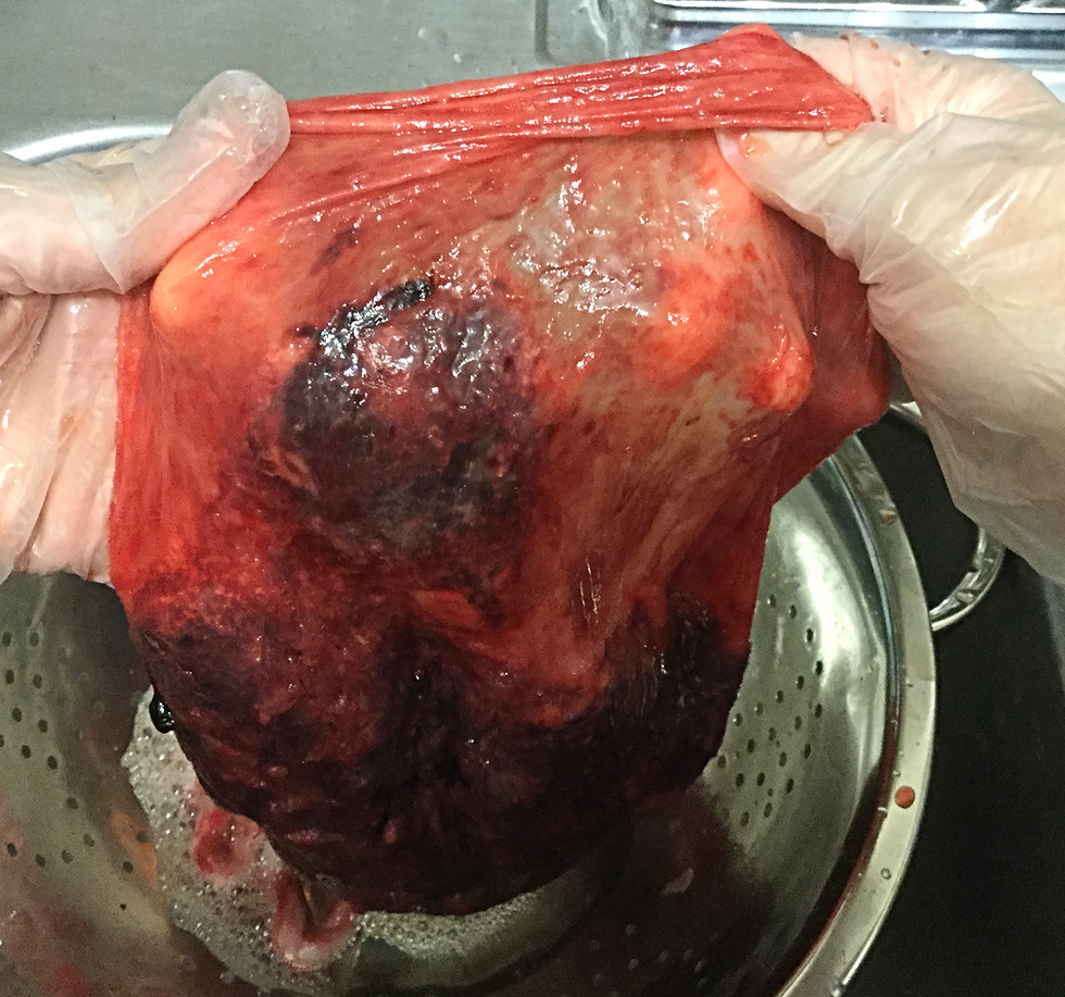 Succenturiate Lob from the mother's side of the sac.