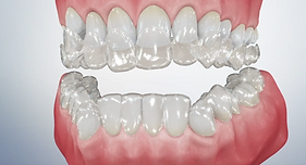 clear aligners.png