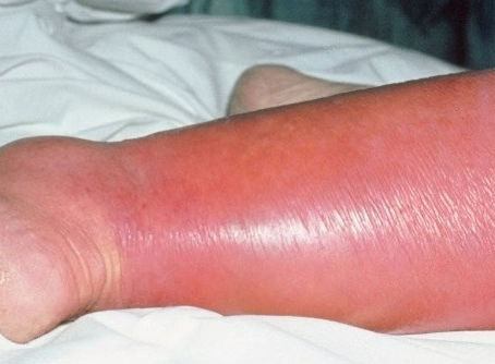Cellulitis, What You Need to Know