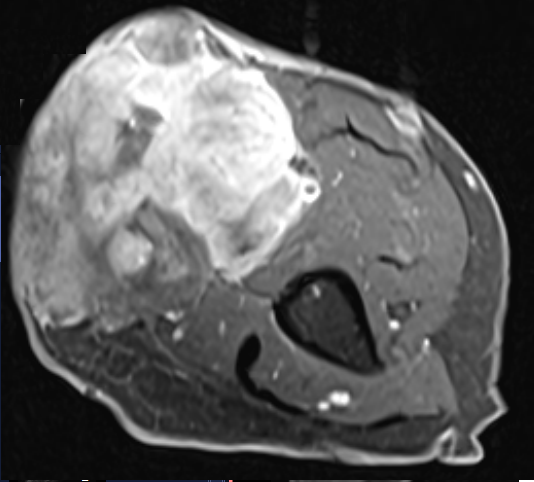 Sarcoma de Alto Grau do braço2.png