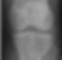 Osteocondroma joelho.png