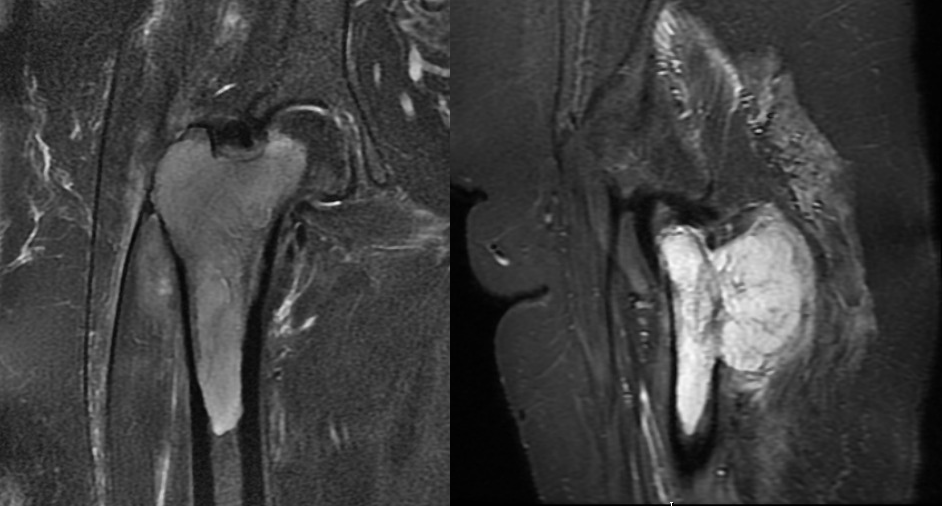 Condrossarcoma Grau 2 do Quadril.png
