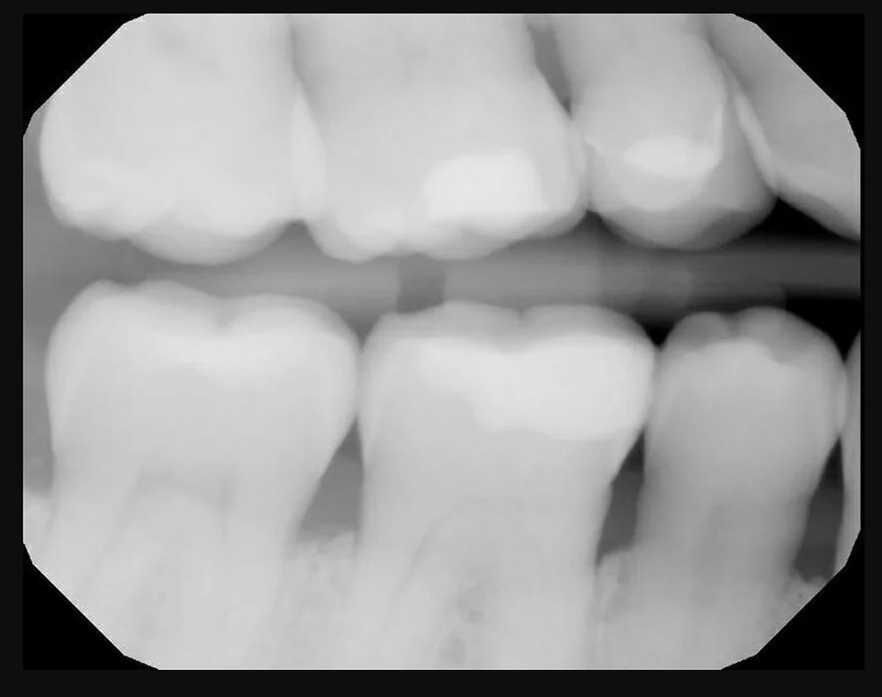 Dental X-ray of upper and lower molars in grayscale, showing teeth and roots against a dark background.