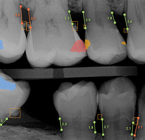 A Digital Dental X-ray Annotated by AI