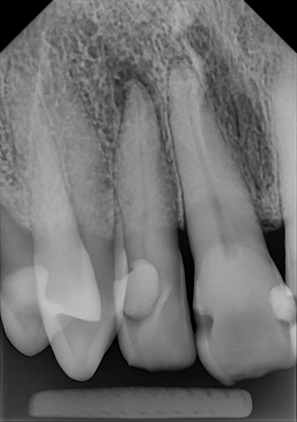 MTF = ROI: How the DC-Air™ Direct Conversion Dental X-Ray Sensor Turns Clear Imaging Into Profit