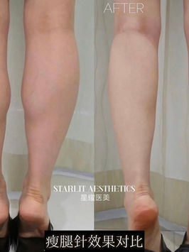 Xeomin calf slimming treatment before and after at Starlit Aesthetics