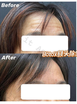Allergan BOTOX Cosmetic forehead wrinkles before and after at Starlit Aesthetics
