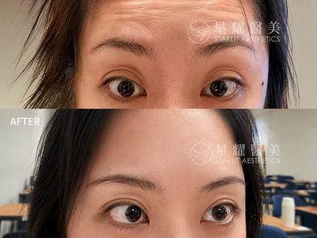 How Much Does BOTOX® Cosmetic Cost?