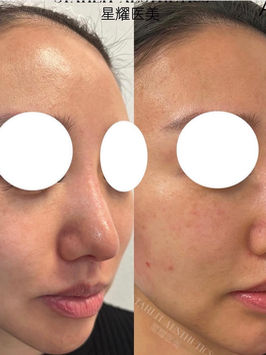JUVÉDERM VOLUMA facial balancing before and after at Starlit Aesthetics