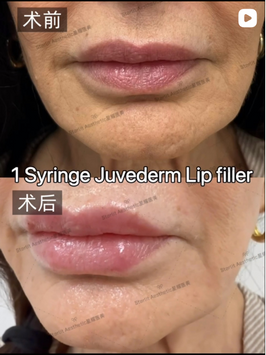 One syringe JUVÉDERM lip filler before and after at Starlit Aesthetics Pasadena