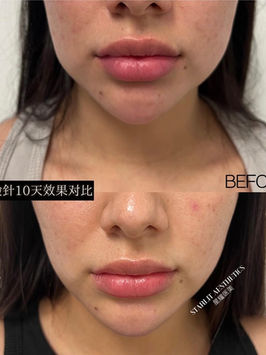 Xeomin masseter treatment before and after at Starlit Aesthetics
