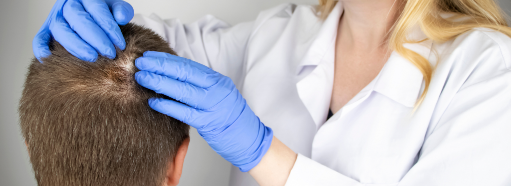 Calvície: como tratar e prevenir