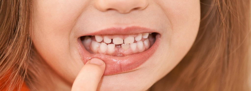 coleta de células-tronco do dente de leite