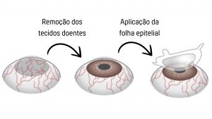 Córnea do olho danificada