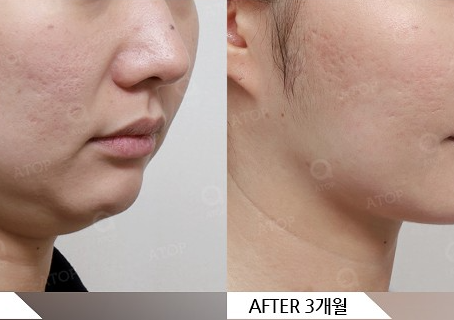 Mini Facelift that Even Improves Nasolabial Folds: The Upgraded Fox Lifting