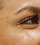 crows-feet-botox-treatment.jpeg
