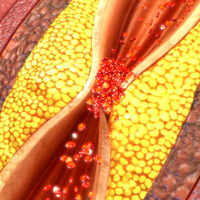 Atherosclerosis: A Fatal Start