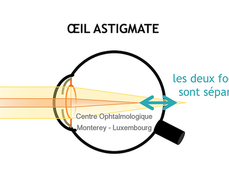 L’opération de l’astigmatisme