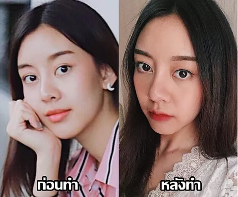 lip surgery